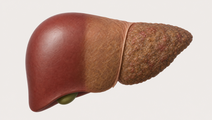 maf 5 score and liver related event risk in a screening cohort