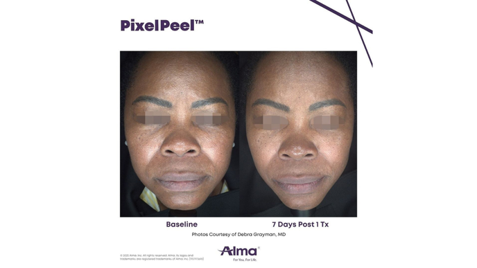 PixelPeel results Alma