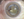 Figure 1. The temporal iris exhibits atrophy. The IOL appears to be in the bag and
shows slight nasal decentration. Cortical lens material surrounds the IOL. It is difficult
to visualize the anterior capsulotomy.