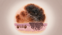 Dermoscopic melanoma lesion with residual nevus component and layered skin architecture