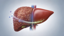 phase 3 bepirovirsen trial reports hbsag loss in chronic hepatitis b