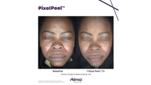 PixelPeel results Alma