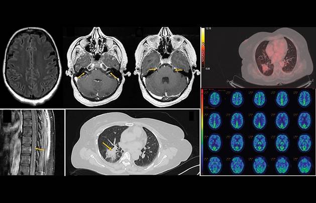Rapidly Progressive Dementia and Plateau Waves A Rare Presentation of Leptomeningeal Disease
