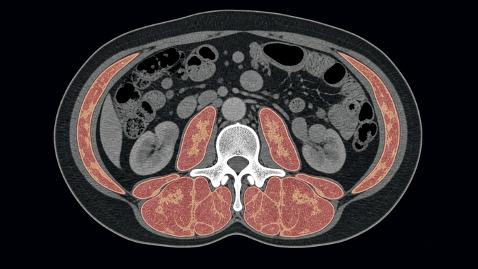 Abdominal CT slice showing low skeletal muscle mass and density in a cancer patient