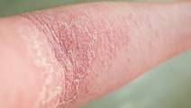 Atopic Dermatitis