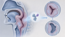 lonvoguran ziclumeran lowers hereditary angioedema attacks