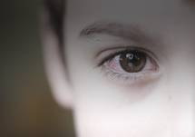 Using a Biologic in a Patient with Atopic Dermatitis and HSV Keratitis