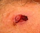 Cutaneous Signet Ring Squamous Cell Carcinoma Case Presentation and Brief Literature Review