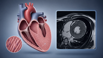 trientine in hypertrophic cardiomyopathy phase 2 trial