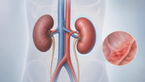 Peritonitis Before Kidney Transplant Linked to Worse Outcomes