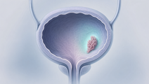 sasanlimab plus bcg in crest improves event free survival