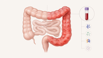 Five Blood Markers Linked to IBD Endoscopic Inactivity