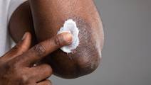 topical corticosteroids