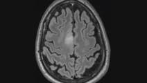Challenge Case Report New Onset Seizures