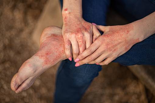 Psoriasis