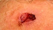 Cutaneous Signet Ring Squamous Cell Carcinoma Case Presentation and Brief Literature Review