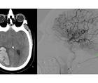 Spontaneous Intracranial Hemorrhage Secondary to Rare Pial Arteriovenous Fistula Rupture