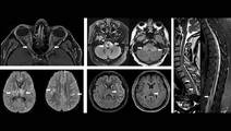 MS Minute Myelin Oligodendrocyte Glycoprotein AntibodyAssociated Disease