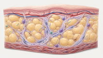 HIV Associated Adipose Fibrosis Linked to Insulin Resistance