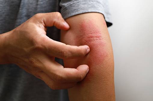Atopic Dermatitis