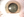 Figure 1. An anterior subcapsular cataract is evident, and a
Visian ICL is in position.