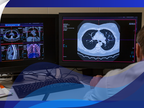 ESTI Refines Pulmonary Nodule Management in Lung Cancer Screening