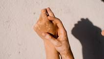 vitiligo