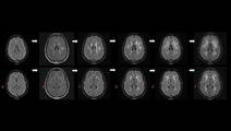 An Unusual Case of Adult Onset Rapidly Progressive Leukoencephalopathy Associated With POLR3B Related Sequence Variati