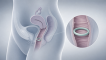 Simplified vaginal anatomy showing an intravaginal TDFFTC ring for local HIV PrEP drug delivery
