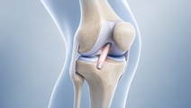 blood flow restriction after acl reconstruction shows no added benefit