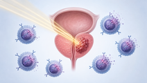 Prostate Radiotherapy Linked to Persistent T Cell DNA Damage