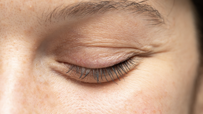 Blepharoplasty
