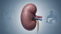 Diabetic Donor Kidneys Five Year Outcomes After Matching