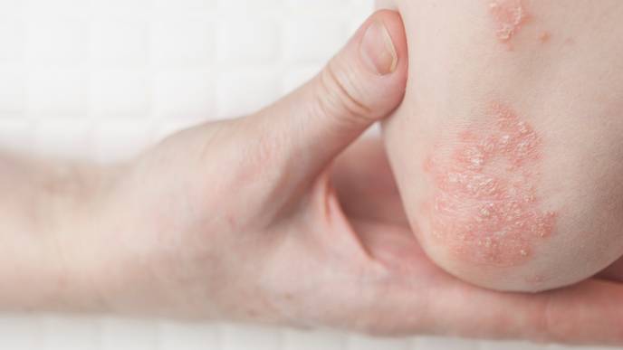 psoriasis