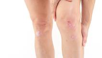 Psoriatic arthritis