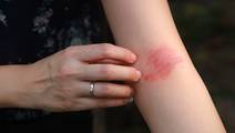 Atopic Dermatitis