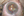 Figure 3. An I/A unit was used to remove the retained
cortical material.