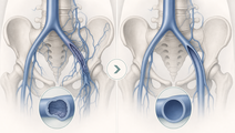 c tract trial endovascular therapy lowers pts severity improves qol