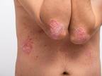 Psoriasis