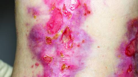 Epidermolysis Bullosa