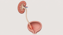 robotic versus laparoscopic radical nephroureterectomy in utuc t3 ivr signal
