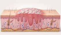 vunakizumab efficacy across baseline psoriasis duration and severity