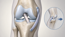 acl reconstruction with let in athletes randomized trial findings