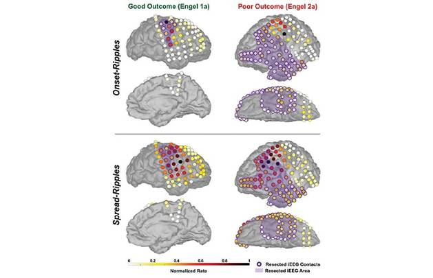 Epilepsy Essentials Novel Interictal Biomarkers for Delineating the Epileptogenic Zone in Children With Drug Resistant Epile