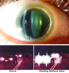 PHARMACOLOGICAL PRESBYOPIA TREATMENT CONSENSUS STATEMENT: CL