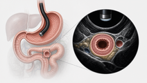 Endoscopic ultrasound anatomy showing stomach and cross sectional target bowel loop in EUS guided gastroenterostomy