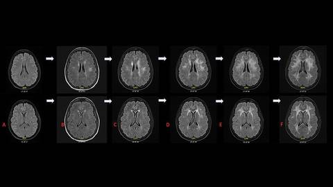 An Unusual Case of Adult Onset Rapidly Progressive Leukoencephalopathy Associated With POLR3B Related Sequence Variati