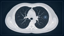 ai assisted lung nodule evaluation in low dose ct screening