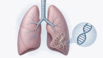 Simplified lungs with fibrotic change and a DNA helix representing MICA 129 in idiopathic pulmonary fibrosis