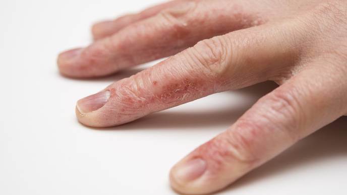 Chronic Hand Eczema